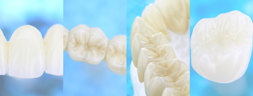 Veneers — 38 Smiles Dental Laboratory